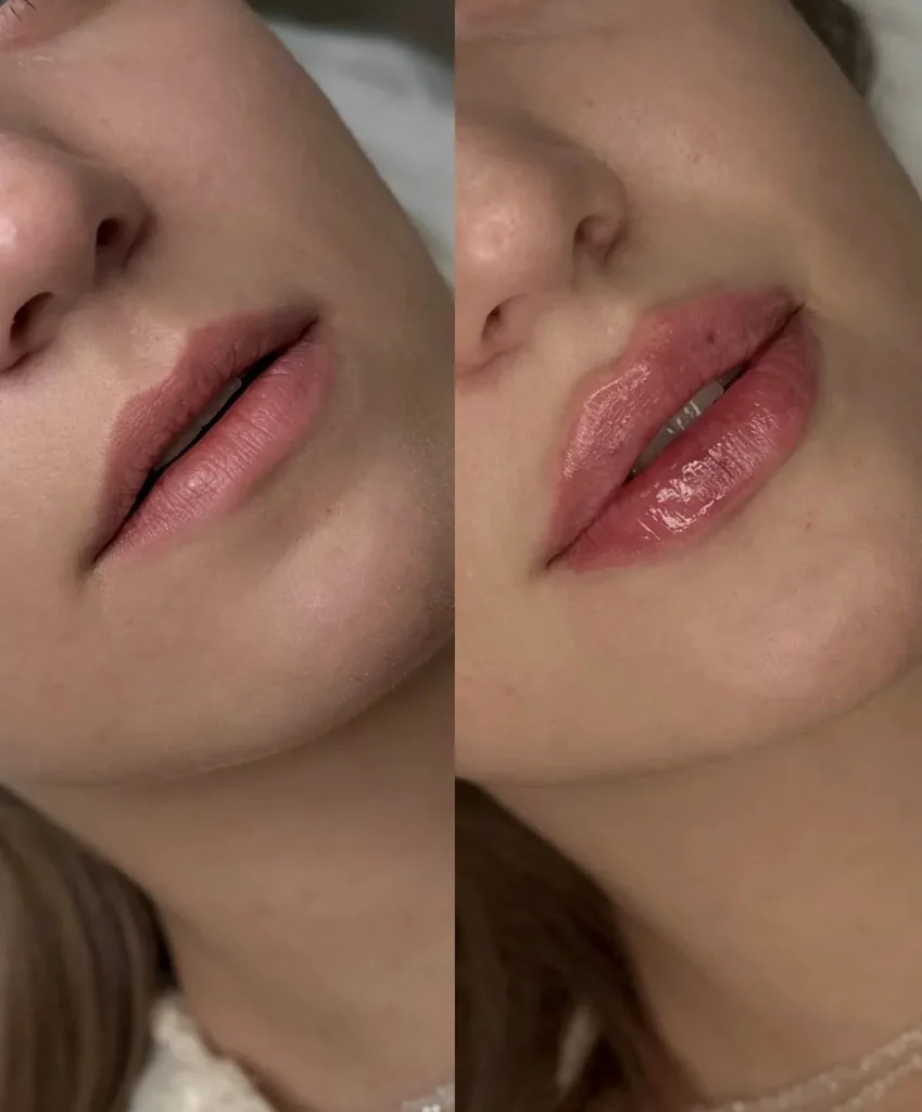 aumento-de-labios-bogota-dra-cami-martinez